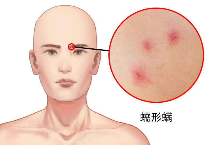 蠕形螨病图片