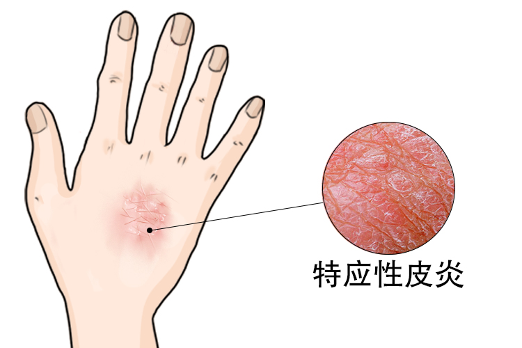 特应性皮炎图片