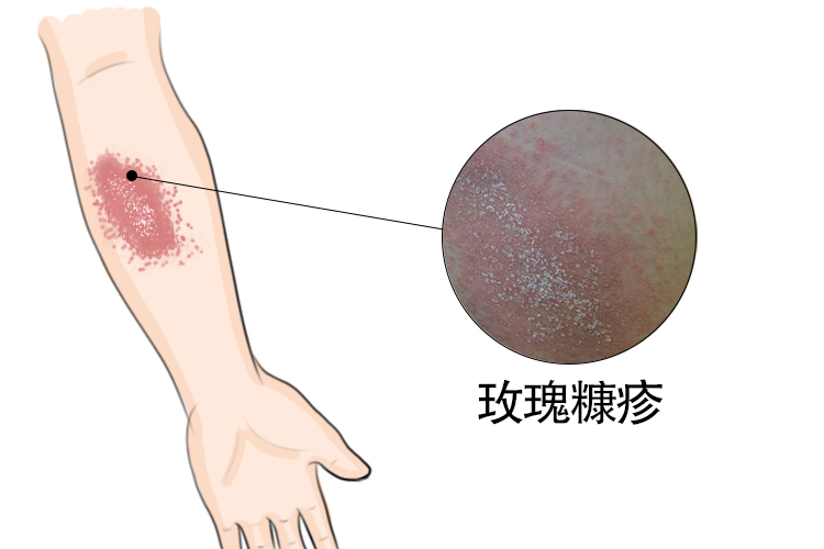 玫瑰糠疹图片