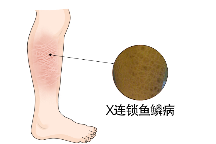 性连锁鱼鳞病图片