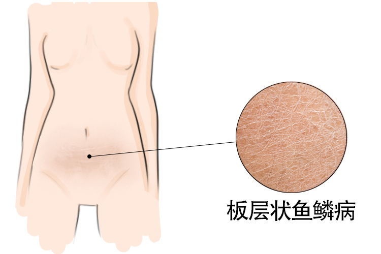 板层状鱼鳞病图片