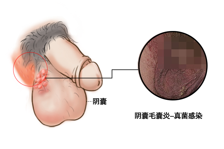 真菌感染图