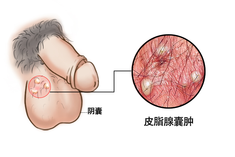 皮脂腺囊肿图