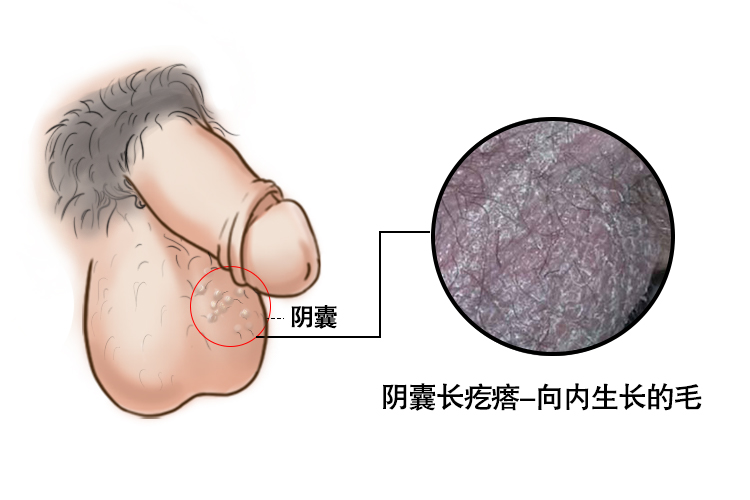 阴毛向内生长图