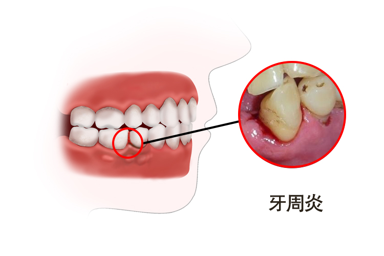 牙周炎图片