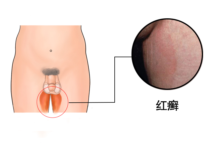 大腿内侧红癣图