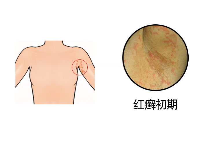 腋窝红癣图