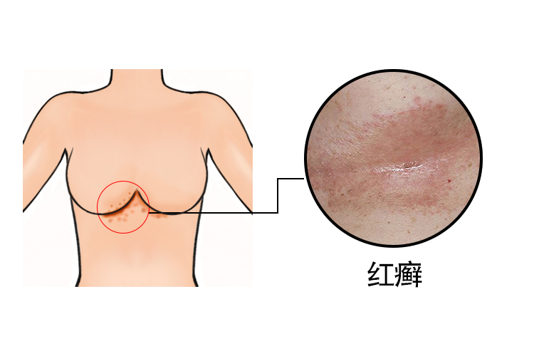 乳房下红癣图