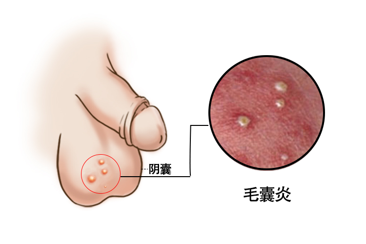 阴囊毛囊炎图