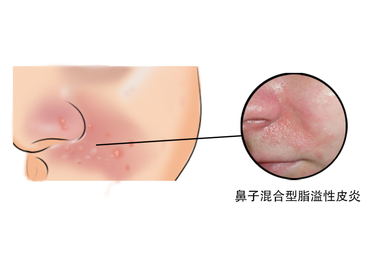 混合性脂溢性皮炎图