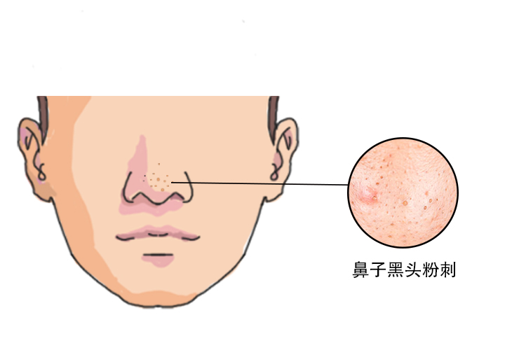 黑头草莓鼻1