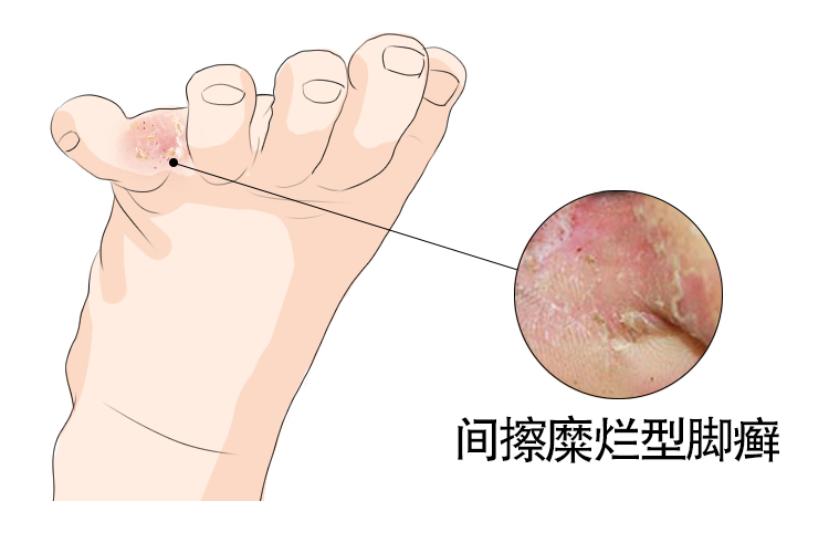 糜烂型足癣图片