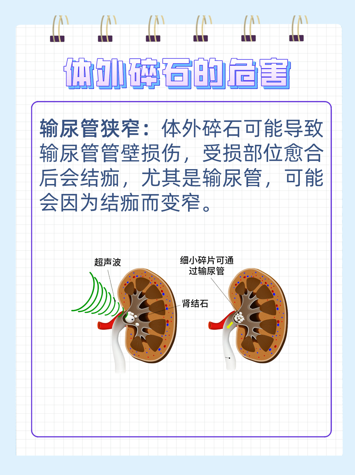 体外碎石广告图片