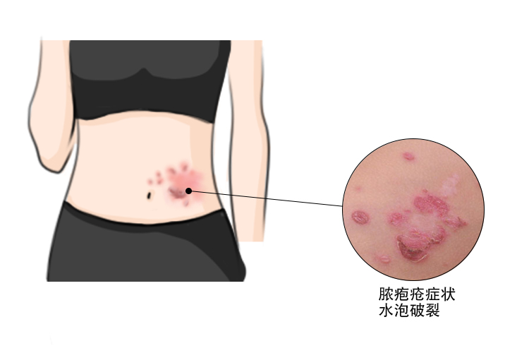 黄水疮能自愈吗图片